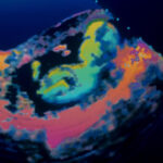 Magyarországon eddig nem használt módszerrel végeztek műtétet egy magzaton az anyaméhben