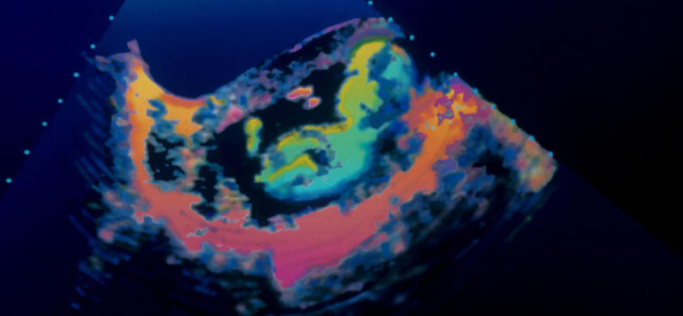 Magyarországon eddig nem használt módszerrel végeztek műtétet egy magzaton az anyaméhben