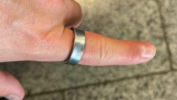 Megsérült az akkumulátor, rászorult a Samsung okosgyűrűje a felhasználó ujjára – fotók