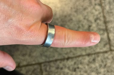 Megsérült az akkumulátor, rászorult a Samsung okosgyűrűje a felhasználó ujjára – fotók